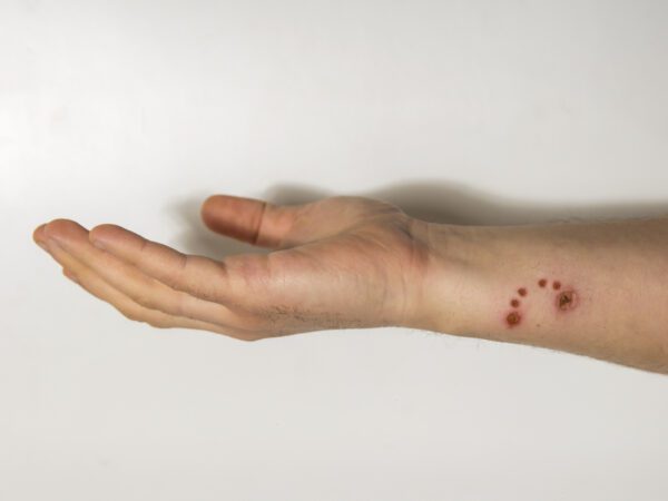 gebeten door een hond in arm